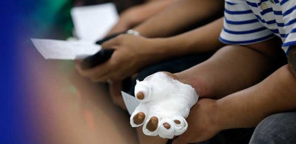 Exhorta IMSS no utilizar pirotecnia, puede provocar amputaciones