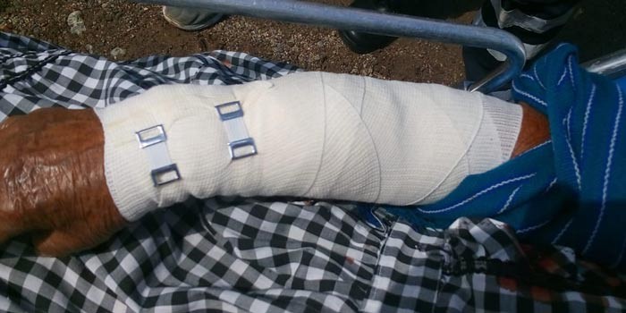 Tres lesionados en el funeral de un menor en Duarte, explotó un cohete