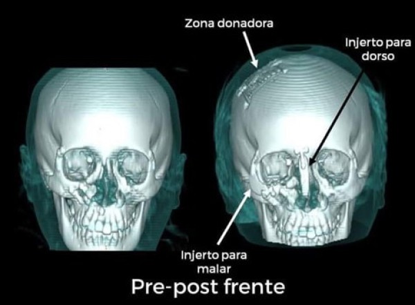 Realiza Hospital Pediátrico de León primera cirugía por Impresión 3D