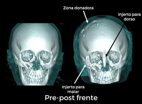 Realiza Hospital Pediátrico de León primera cirugía por Impresión 3D