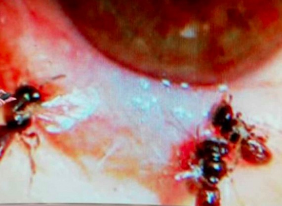 Doctor extrae cuatro abejas ¡del ojo de una mujer!