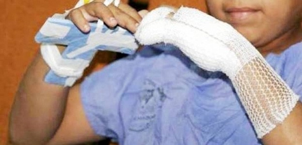 Centro de Cuidados Críticos atendió a 118 niños quemados, principalmente por líquidos en la cocina