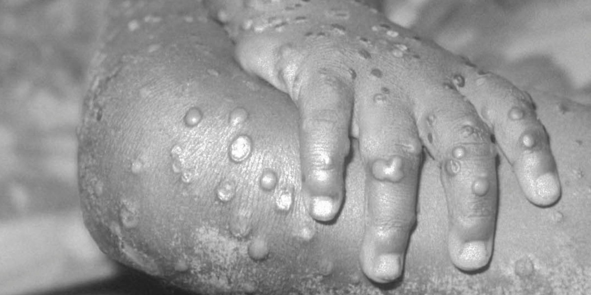 Confirman 4 casos de viruela símica en Guanajuato