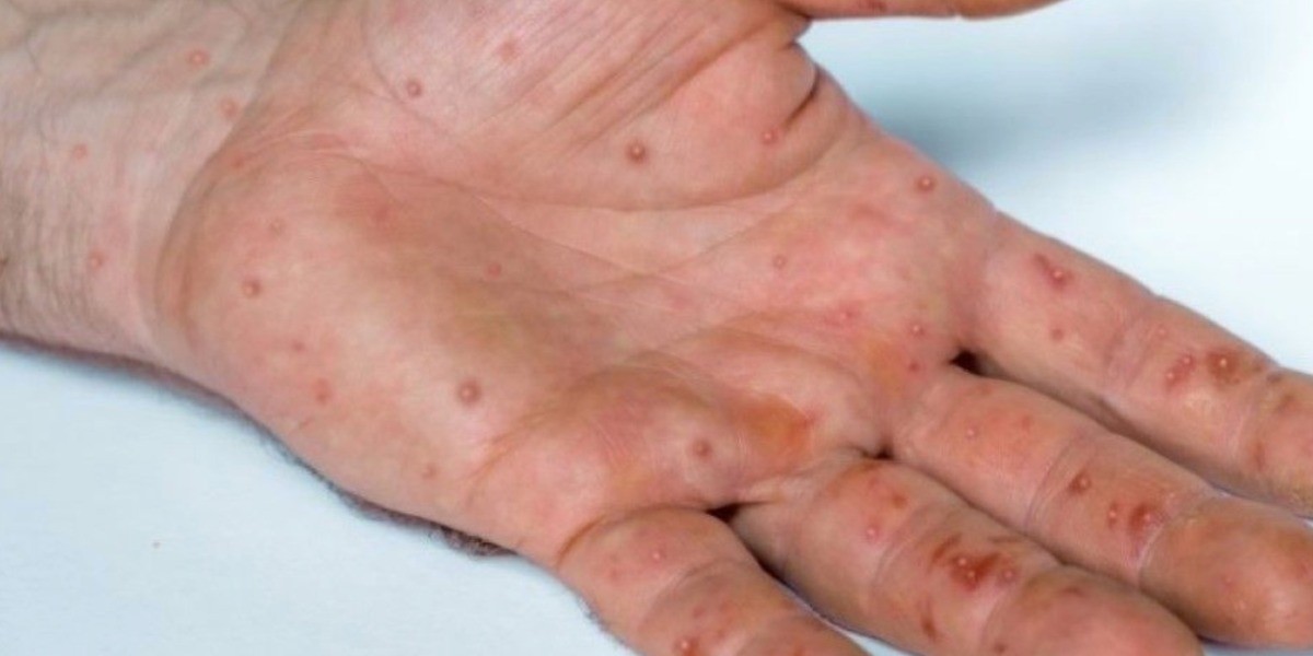 Confirman otro caso de viruela símica en Guanajuato