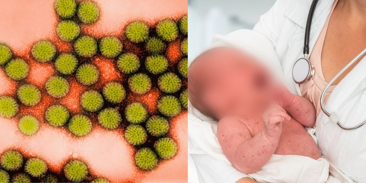 Detectan 15 casos de rotavirus en Celaya
