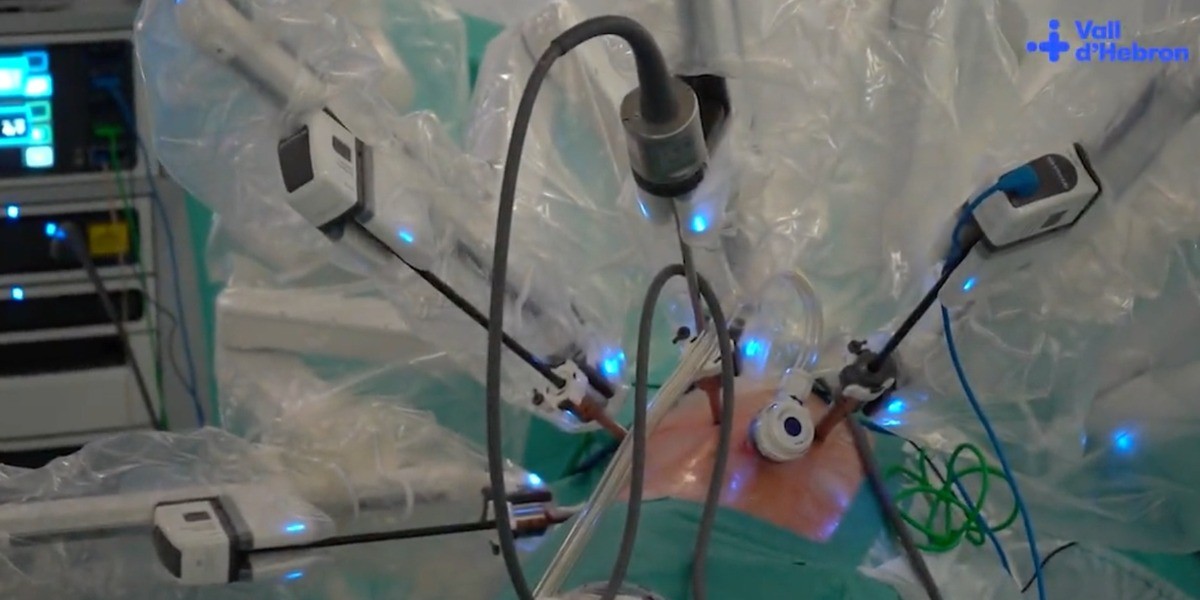 Realizan trasplante pulmonar ¡sin abrir el tórax del paciente!