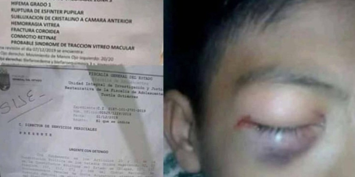 (VIDEO) Alumno agredido en secundaria podría perder parcialmente la vista