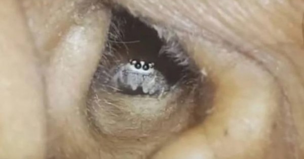 Hombre descubre araña y nido en su oído durante revisión médica