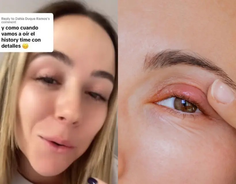 La perrilla se puso rara... Mujer revela que tuvo un gusano en su ojo durante 4 años