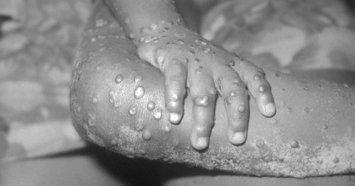 ¿Cómo se transmite el MPOX (viruela del mono)?