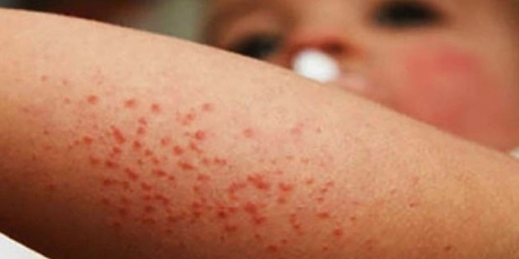 Guanajuato refuerza vigilancia epidemiológica ante brote de sarampión en el país