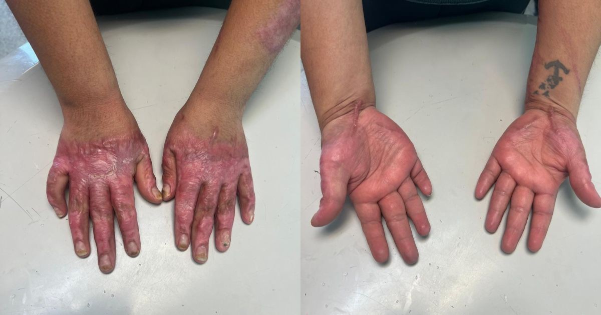 Médicos del IMSS en León salvan la vida y extremidades de mujer tras explosión por fuga de gas