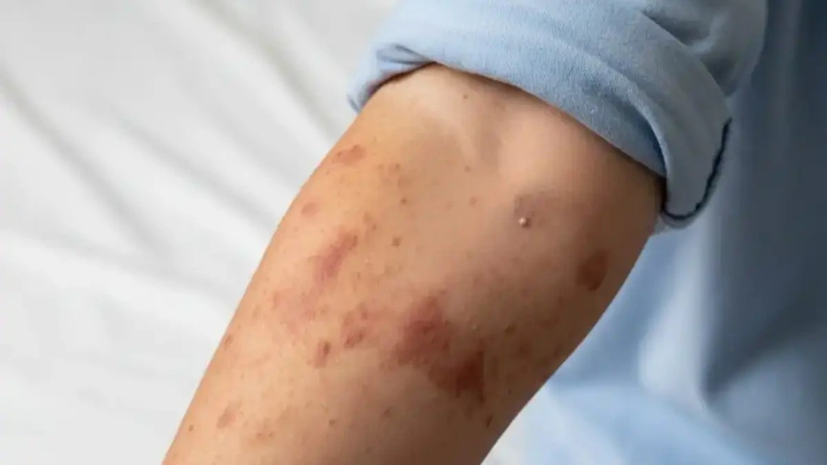 Detectan segundo caso de sarampión en el estado de Guanajuato