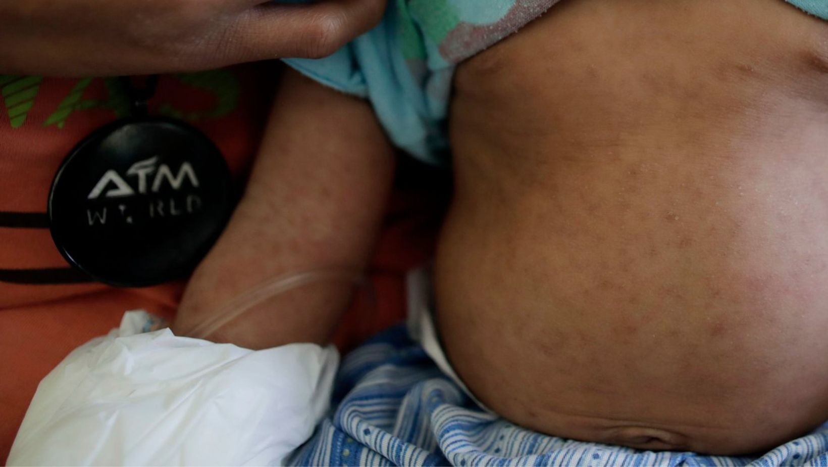 Guanajuato confirma tercer caso de sarampión en León; bebé no tenía esquema de vacunación