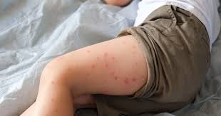 Alertan por “amnesia inmunológica” tras contagios de sarampión