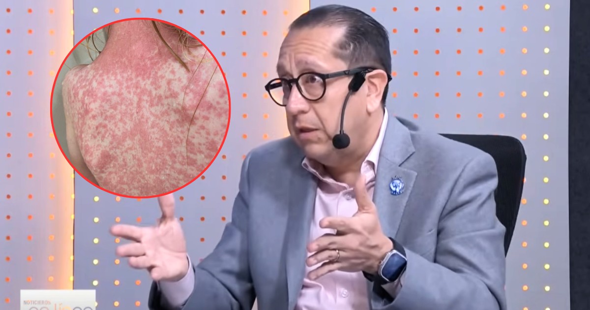 Posible sexto caso de sarampión en Guanajuato; autoridades esperan confirmación federal