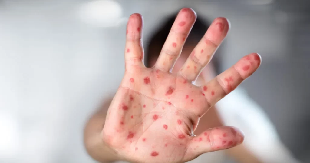 ¡Vuelve el sarampión! Guanajuato registra primer caso en menor de edad